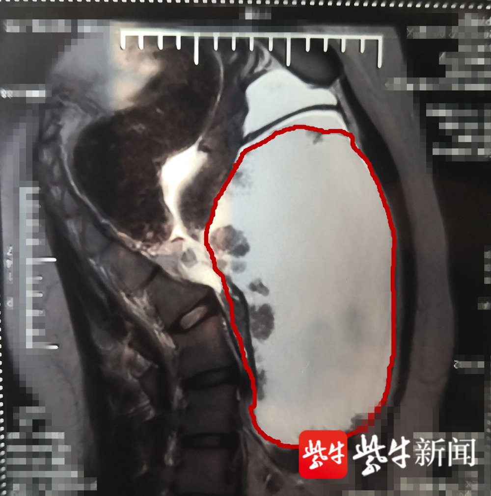 b超显示,15岁的小萱体内有一个直径约20厘米的肿瘤.(院方供图)