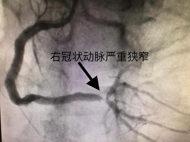 武汉"非新冠"患者就医恢复:有患者马上进行心脏支架手术