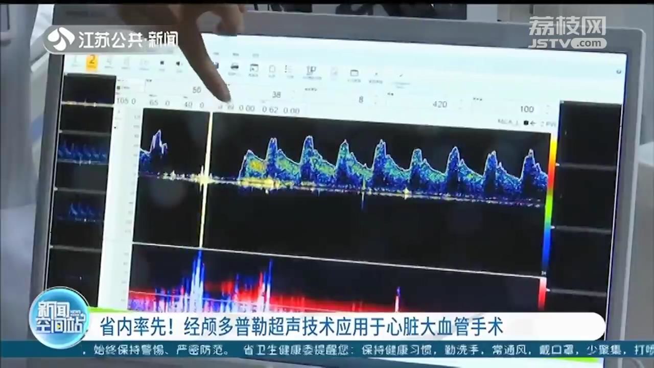 经颅多普勒超声技术应用于心脏大血管