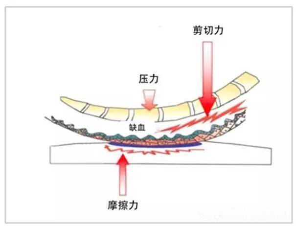 器械相关压力性损伤原理