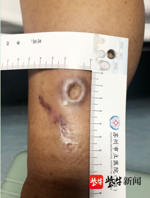 以为擦破点皮,3个月后竟要手术和植皮!记住:皮肤"挫伤"和"擦伤"不一样