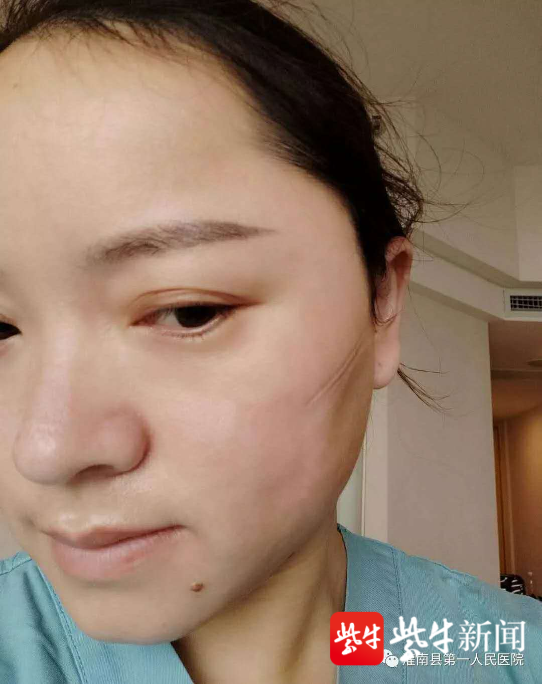 周周的妈妈张春兰脱掉防护服时,脸上留下一道道压痕.