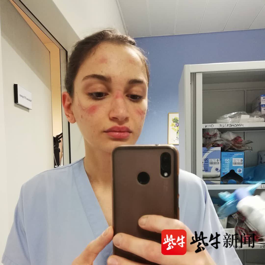 阿丽西亚贴出脸上带有深深印痕的照片