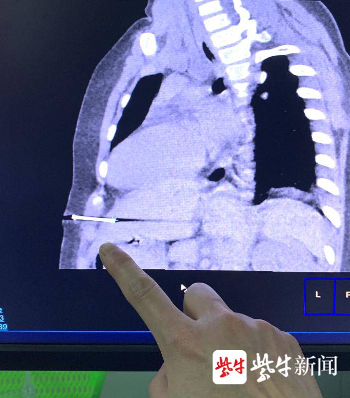 六岁女童玩射钉枪,一枪钢钉射入腹部距心脏仅2.6厘米