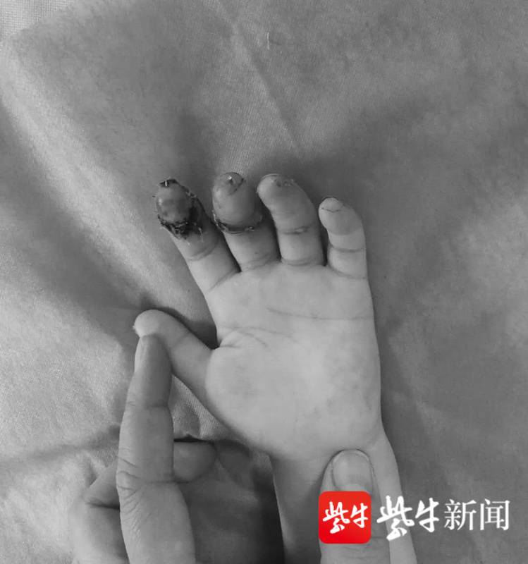 疼!3岁宝宝两根手指被硬生生挤断
