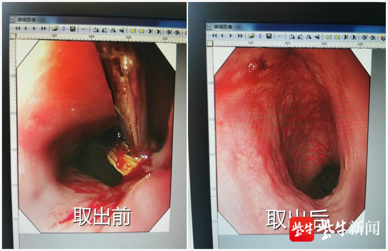 喉咙取出鱼刺图片图片