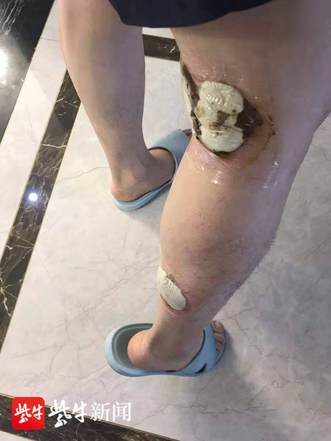 潘孝云腿部刚做过手术