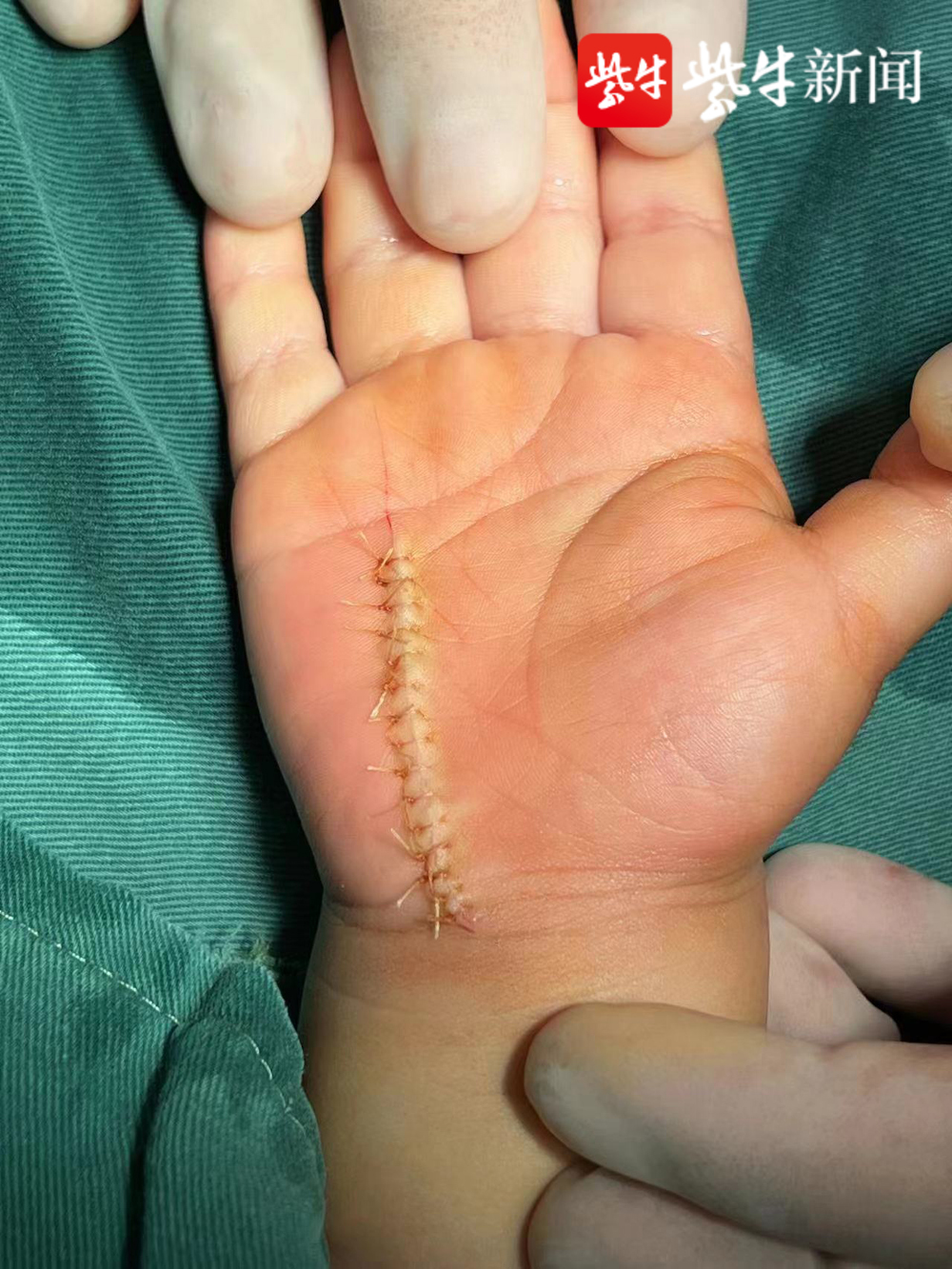 男童手掌神经血管断裂 医生显微镜下在直径2毫米血管上做 针线活