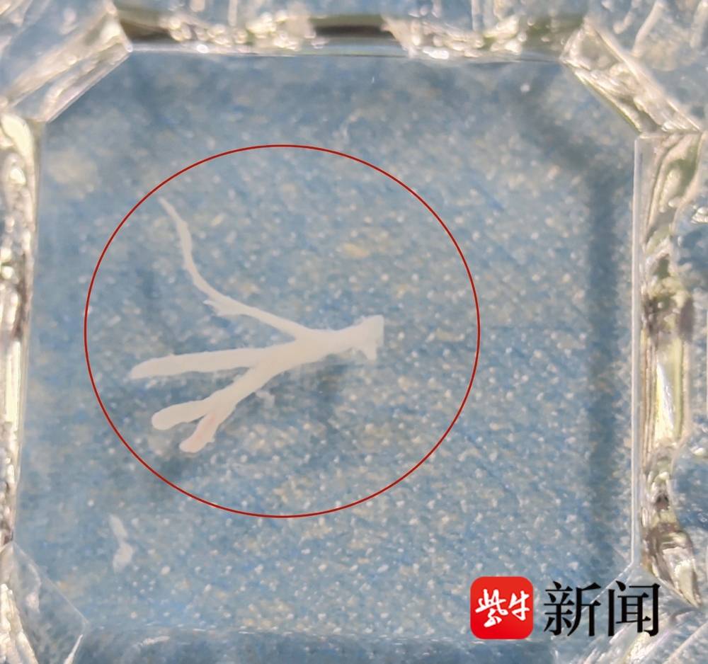 从患儿体内取出的树脂妆痰栓像一颗“小树”前段时间，桐桐突然发起高烧