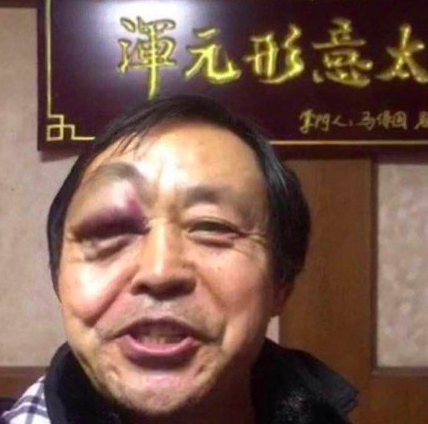 鼻青脸肿的马保国