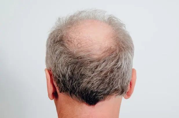英国疫情研究称,头发少的男性要小心了