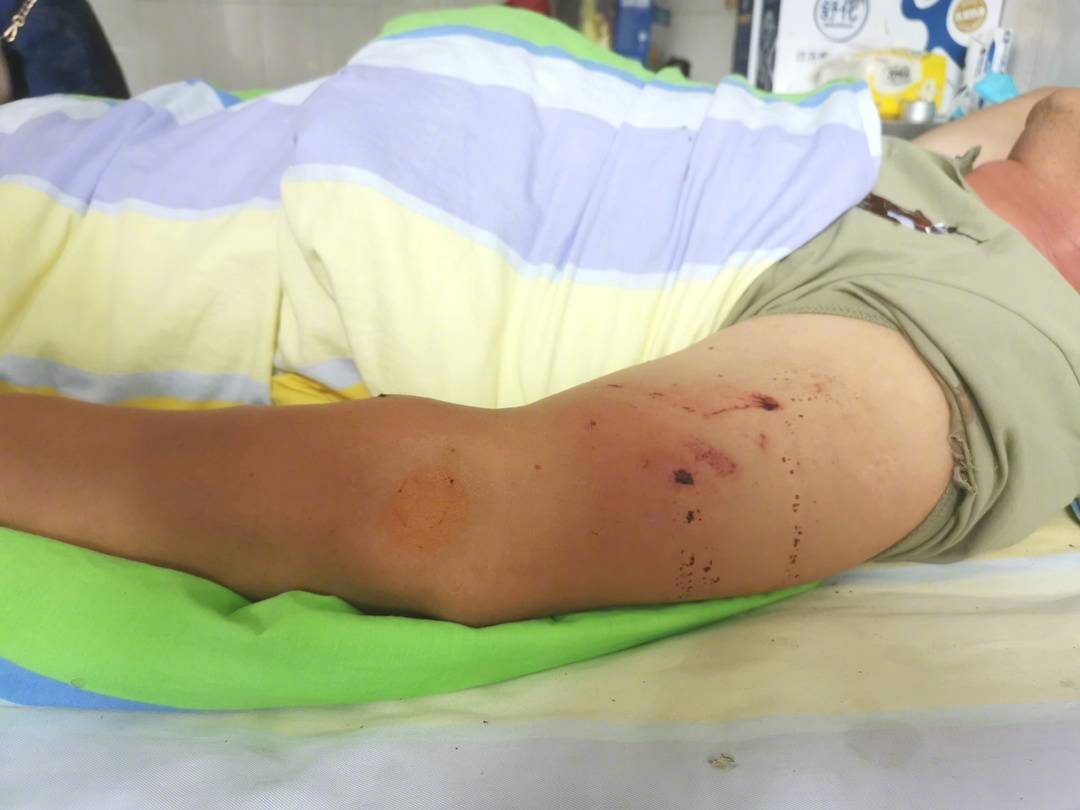 腰椎压缩性骨折,景区表示可报销医疗费