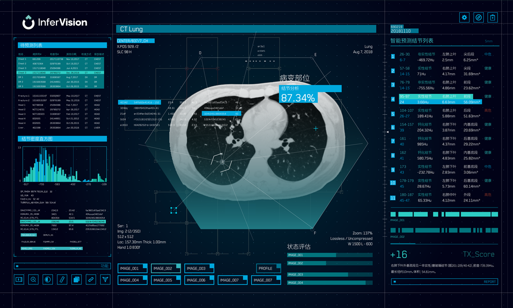 推想科技的肺部人工智能辅助诊断界面.(受访者提供)