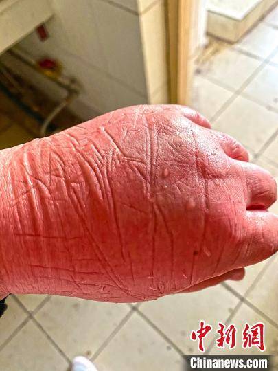 医疗队员被冻伤的手.图片由陆军军医大学士官学校附属医院提供