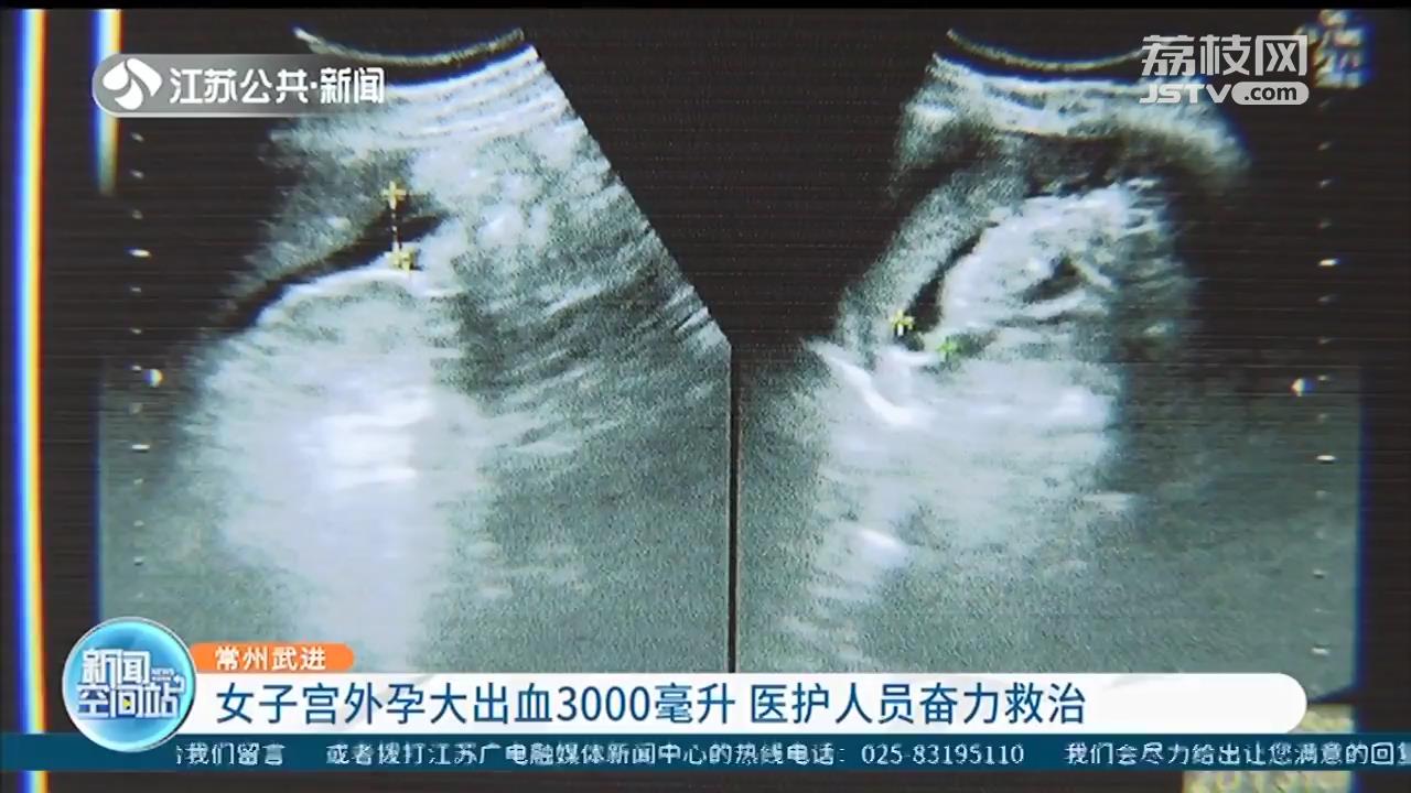 宫外孕单子图片确诊图片